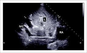 Hypovolemia With Dual Lumen Cannula In The Inferior Caval