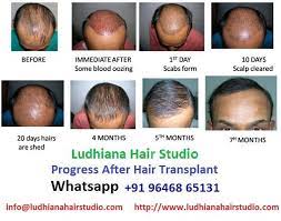 Are You Looking For Best Centre Of Hair Transplantation In Ludhiana Dr Rohit Garg S Clinic Is Best Hair Transplant Facial Hair Transplant Fue Hair Transplant