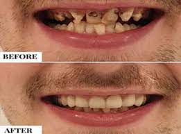 Find out how to fix crooked teeth. Best Way To Fix Crooked Teeth Stunning Dentistry Blog