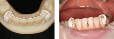 But in general, the best retainer for mewing is the fixed retainer, since only the front teeth are locked and you're not potentially rocking the teeth back and forth by switching between mewing and the retainer every day. A New Type Of Fixed Retainer Orthodontic Practice Us