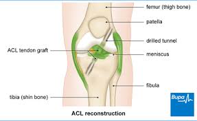 Let's take a closer look at what needs to happens, in rough chronological order. Anterior Cruciate Ligament Acl Reconstruction Health Information Bupa Uk
