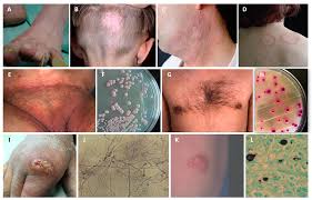 Image result for penis mycosis symptoms
