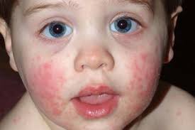 Image result for red rash face