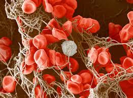 Blood Clots Leave Clinicians With Clues About Covid 19 But No Proven Treatments
