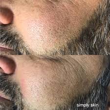 Ingrown hair isn't fun, and, if you suffer from it, we feel your pain. How To Remove And Treat Infected Ingrown Hair