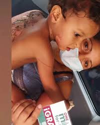 Angel Capote 3 años Procedente de Nueva Cúa Sufrió quemaduras de 3er grado  en la espalda, brazo y una piernita con agua caliente. De inmediato nos  llamaron y se pudo atender la