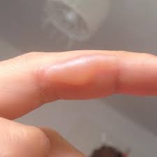 Was Macht Man Bei Einer Brandblase Finger Blase Verbrennung