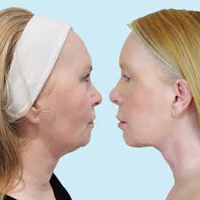 I look ten years younger” Scots woman reveals transformation after  non-surgical lunchtime face lift