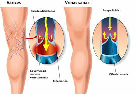 VARICES Y ARAÑAS VASCULARES - Farmacia Salomé
