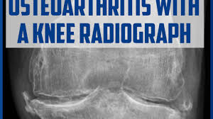 Image result for Knee XRay