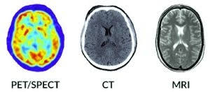 It is used for a wide variety of reasons as accurate and fast as a ct scan can be, the results are sometimes open to interpretation. Biomarkers For Dementia Detection And Research National Institute On Aging