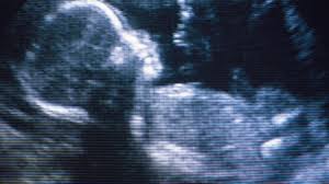 What Crown Rump Length Crl Means On Ultrasound