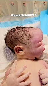 Image result for Brow Presentation