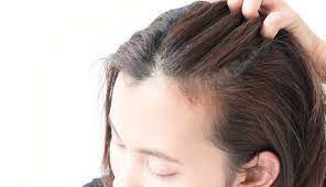 生え際 前髪が薄毛の女性に円形脱毛症の可能性は 見分け方も解説 hairlly 薄毛 女性のヘアスタイル 薄毛 女性