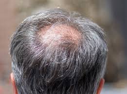 Bryces hair swirls in both directions. Hair Loss Explained How And Why Men Go Bald The Independent The Independent