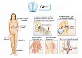 Hausmittel Gegen Gicht Verwendung Nutzen Fur Gesundheit Gesundpedia De Gicht Gicht Hausmittel Gicht Ernahrung