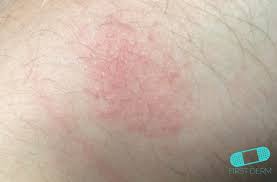 Lyme Disease