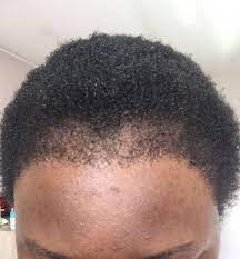 This procedure is sometimes referred to as the no visible scar hair restoration method. Black Female Hair Transplant With Longevita Review Realself