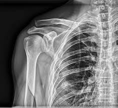 Image result for Shoulder XRay