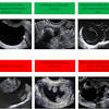 These findings are typical of follicular cysts of the ovaries. 1