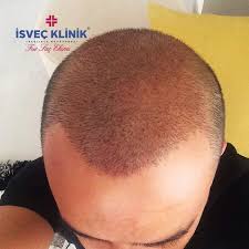 Isvec Klinik Sac Ekimi Sonrasi Hastamizin Ilk Ayinda Sac