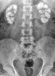 Kidneys Medullary Nephrocalcinosis Medical Art Radiology Radiography