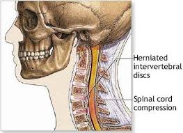 Cervical Spondylosis Active Care Physiotherapy Clinic