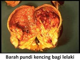 Kerap membuang air kencing terutama pada waktu malam. Kencing Tak Lawas Bagi Lelaki Wannura Terapi