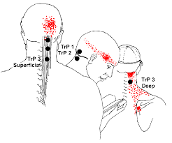 Pain Back Of Neck Head Left Side Page 5 Line 17qq Com