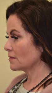 Update to one of my recent facelift, necklift, and eyelid lift patients.  She’s about 8 weeks out and healing great with a wonderful result. Notice  how her incisions are nearly invisible. She looks ...