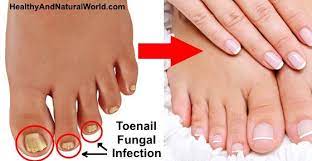 2 Ingredient Natural Remedy To Get Rid Of Nail Fungus Fast Easy Toenail Fungus Remedies Nail Fungus Cure Toenail Fungus Cure