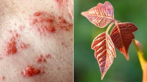 Check spelling or type a new query. What Does Poison Ivy Look Like Everyday Health