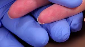 Image result for Capillary Puncture