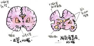 ▍ 路易氏體失智症 路易氏體失智症（dementia with lewy bodies，縮寫為 dlb）是退化性失智症中僅次於阿茲海默症，第二常見的失智症。 æˆ'æƒ³å¿µæˆ'è‡ªå·± æ—©ç™¼æ€§å¤±æ™ºç—‡ è…¦å­é†'äº†