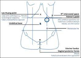 This site (3 cm below the left costal margin in the midclavicular line) is rarely affected by adhesions, and with splenomegaly and stomach distension being excluded it has been shown to be safe 32, 33. Guideline No 412 Laparoscopic Entry For Gynaecological Surgery Journal Of Obstetrics And Gynaecology Canada