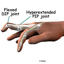 Learn about ways to prevent and treat ra joint deformities. Swan Neck Deformity Of The Finger Orthogate