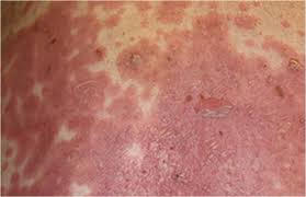 14 steven johnson syndrome pictures. Management Of Stevens Johnson Syndrome Toxic Epidermal Necrolysis A Review And Update Springerlink