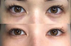 The 16 best under eye concealers to fake a good night's rest. Permanent Under Eye Concealer Tattoo It S Now A Thing Beauticate