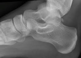 Image result for Calcaneal Apophysitis