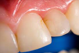 If the brown stains in between your teeth are caused by tartar or medical conditions, it is best to see a dentist. Tooth Discoloration What S Behind Stained And Yellow Teeth