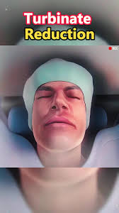 Air Pocket Nasal Turbinate