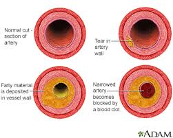Below are diagrams of the heart and its position in the circulatory system. Hardening Of The Arteries Information Mount Sinai New York