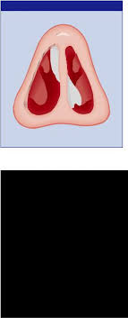 Nasal vestibulitis is a bacterial infection that starts in the hair follicles of the nose. Lecture Notes On Diseases Of The Ear Nose And Throat Bull 2002 Str 10