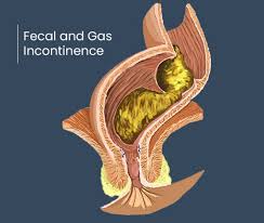 Image result for Fecal Incontinence