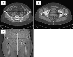 It refers to the anterior extremity of the iliac crest of the pelvis. Variability In The Range Of Inter Anterior Superior Iliac Spine Distance And Its Correlation With Femoral Head Centre A Prospective Computed Tomography Study Of 200 Adults Springerlink
