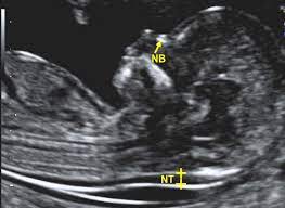 You'll want to talk with your practitioner or a genetic counselor about how to interpret the results, which can. Nuchal Translucency Scan Fmf Certification Welcome To The Fetal Medicine Foundation