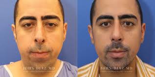 Beverly Hills Plastic Surgeon