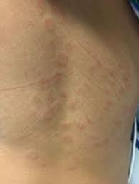 Restore windows 7/8 photo viewer in windows 10. Chop Experts Describe Types Of Rashes Associa Eurekalert