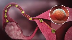 The specific type of surgery depends on the location and extent of the fallopian tube blockage. Blocked Fallopian Tubes And Chances Of Conception