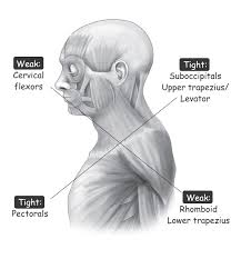 Upper Crossed Syndrome Causes Symptoms Diagnosis Treatment Prevention